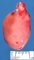 Testicular infarction by spermatic cord torsion
