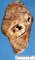 Pulmonary hydatid cyst