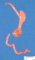 Blind ends duodenal atresia