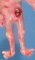 Anal imperforation with microcephaly and fetal immotility syndrome (...)