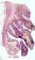 Colonic stenosis in Crohn disease