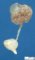 Renal adysplasia (case 11385)