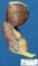 Meckel diverticula