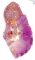 Segmental renal dysplasia and chronic interstitial nephritis in (...)