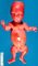 Short humerus in thanatophoric dysplasia (Fetus, 21 weeks - Case (...)
