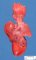 Bilateral pulmonary hypoplasia in bilateral congenital diaphragmatic (...)