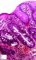 Colonic GVHD