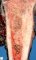 Femoral Ewing sarcoma