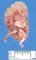 Ureteral duplication with obstructive renal dysplasia