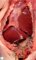 Bilateral diaphragmatic hernia in malformative syndrome