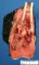 Femoral osteosarcoma