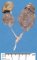 Bilateral diffuse multicystic kidneys