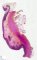 Crohn colitis