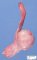 Testicular endodermal sinus tumor (Yolk sac tumor)