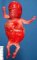Megacystis sequence by urethral obstruction (17 weeks) (Case (...)