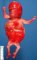 Fetus, 17 weeks. Urethral atresia and megacystis sequence