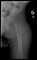 Femoral Langerhans histiocytosis