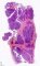 Thymic seminoma