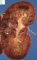 non-syndromal bilateral non-obstructive renal dysplasia