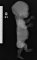 Short humerus in thanatophoric dysplasia (Fetus, 21 weeks - Case (...)