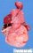 Megacystis with abdominal distension by urethral atresia