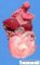 Megacystis with abdominal distension by urethral atresia