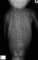 Narrow chest in association sirenomelia-ectrodactyly