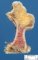 Osteochondroma