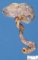 Superior polar pyelorenal duplication with megauretere and hydronephrosis