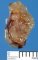 Renal hypodysplasia (Case #11194)