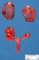 Renal hypodysplasia (Case #11194)