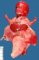 Prune belly sequence by urethral obstruction sequence with megacystis (Case (...)