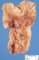 Meckel diverticula