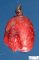 Duodenal duplication cyst
