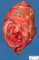Hepatoblastoma