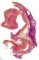 Obstructive renal dysplasia