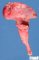Hydronephrosis
