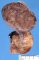 pleuropulmonary blastoma