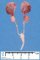 Bilateral renal hypoplasia