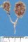 Bilateral diffuse multicystic kidneys