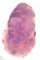 Nodular sclerosing Hodgkin lymphoma