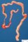 Duodenal dilatation by duodenal atresia in multiple intestinal atresia (...)