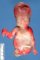Caudal dysplasia and lower limb agenesis in maternal diabetes (Case (...)