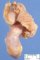 Meckel diverticula