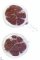 Appendiceal lymphoid hyperplasia (CD20)