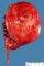 Cystic Wilms tumor