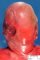 Posterior encephalocele in Meckel syndrome