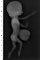 Omphalocele-radial ray aplasia association (13 weeks)