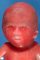 Small face in polymalformative syndrome