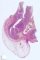 Meckel diverticula with ileal perforation
